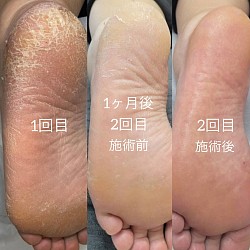 かかと角質ケア