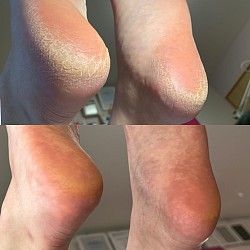 かかと角質ケア