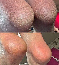 かかと角質ケア