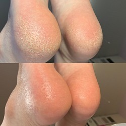 かかと角質