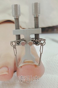 巻き爪ケア