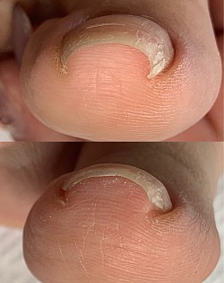 巻き爪ケア