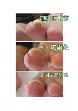 巻き爪ケア