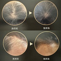 スカルプ棘ケアのビフォーアフター