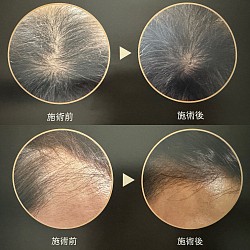薄毛ケア