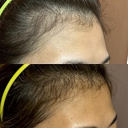 生え際の薄毛にも効果あり