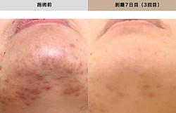 ニキビケアにハーブピーリング