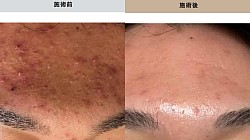 ニキビケアにハーブピーリング
